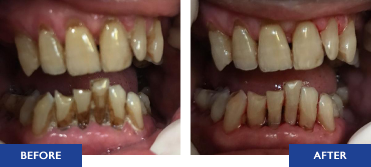 Regular cleaning of teeth - Before and After Actual Patient Result Image 6