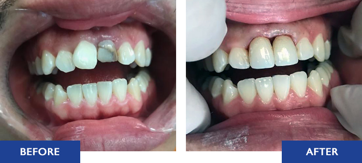 Crowns and Bridges - Before and after actual patient result image 2