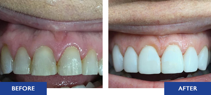 Veneers - Before and after actual patient result image 4