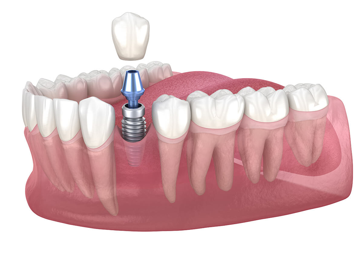 Dentist That Do Implants Near Me in Chino Hills CA Area