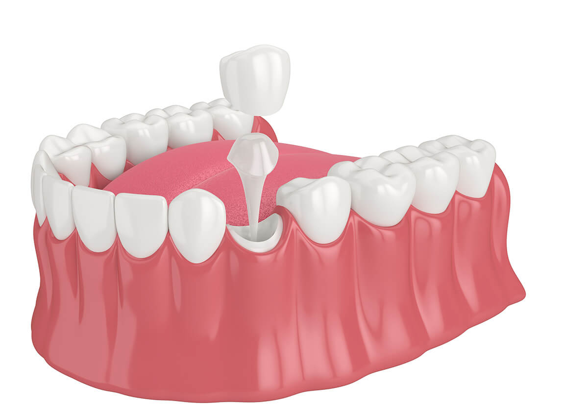 Dental Crowns Treatment in Chino Hills CA Area